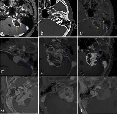 How to Precisely Open the Internal Auditory Canal for Resection of Vestibular Schwannoma via the Retrosigmoid Approach
